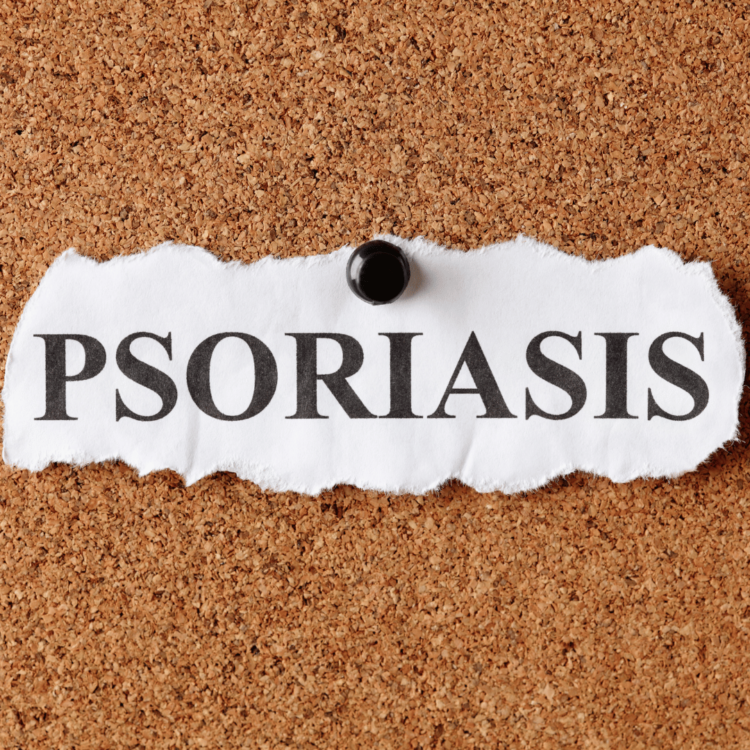 Psoriasi