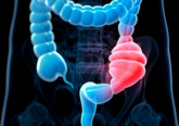tumore al colon