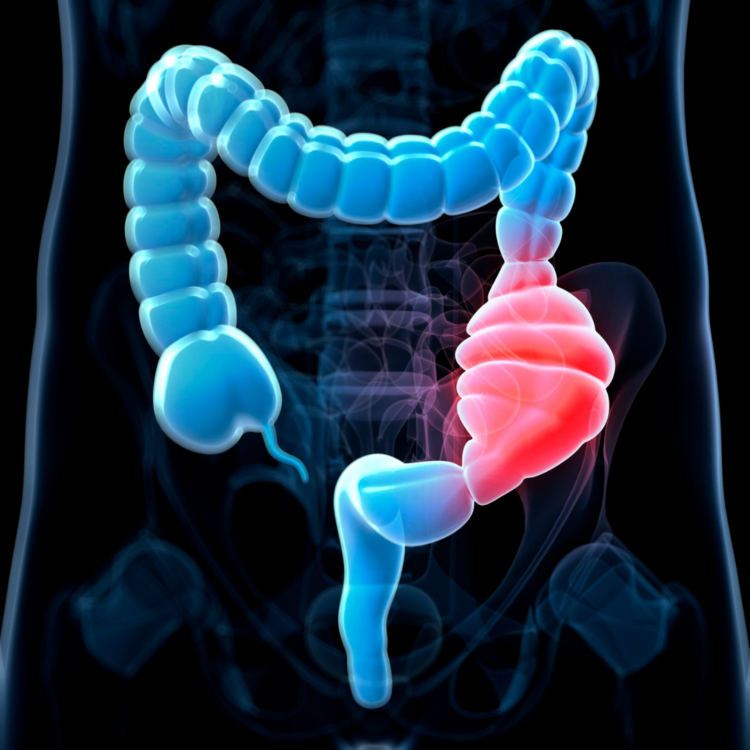 tumore al colon